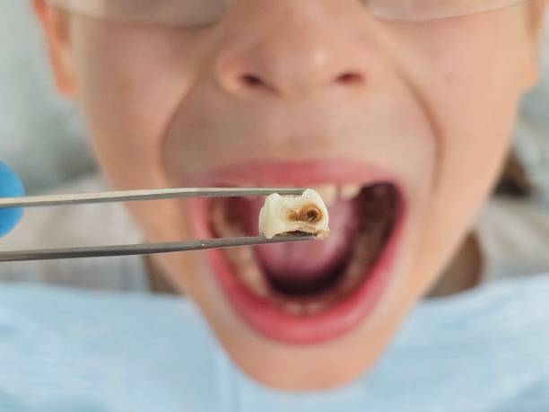 Best Root Canal Emergency Dentist  in Alma, GA